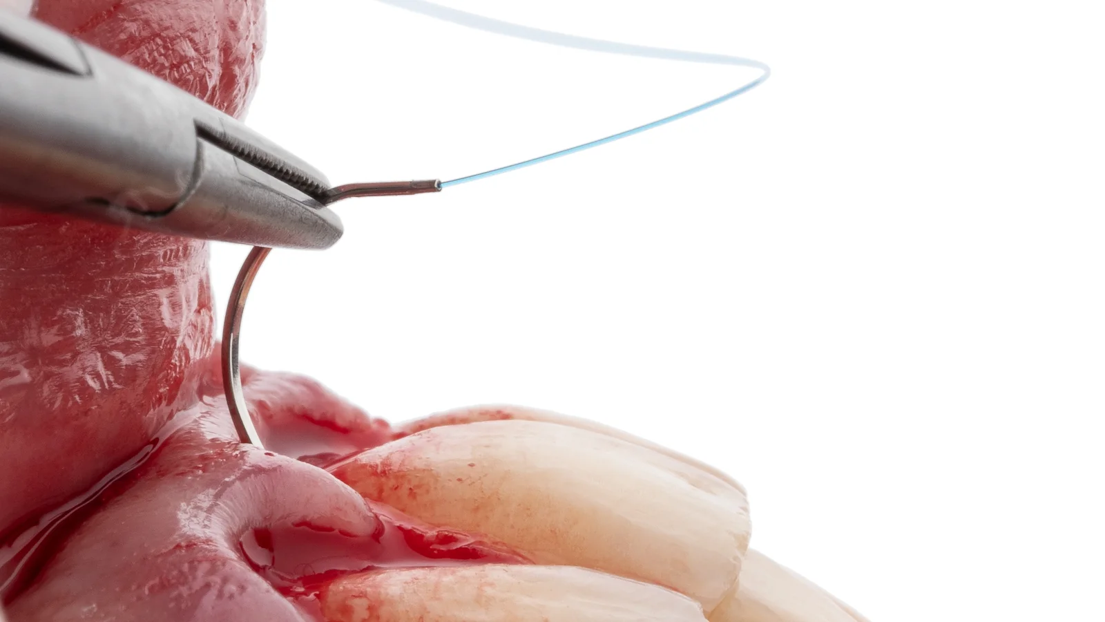 Técnicas de Incisão e Acesso Cirúrgico