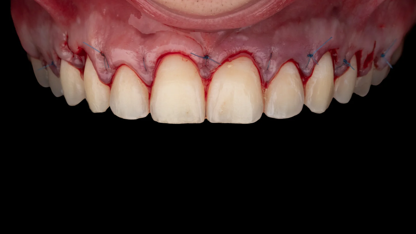 Osteotomia e Osteoplastia de Alta Precisão