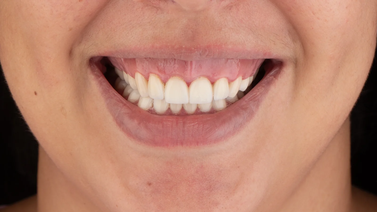 Cirurgia Plástica Periodontal Passo a Passo